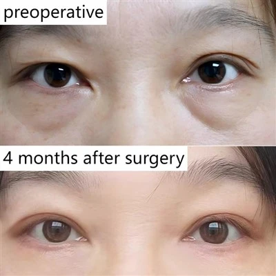 Blepharoplasty