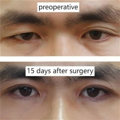 Double Eyelid Surgery