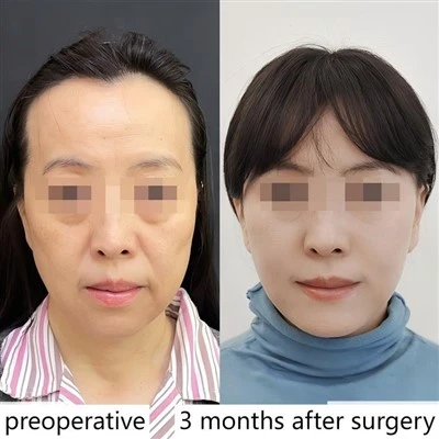 Facial Sagging Lift