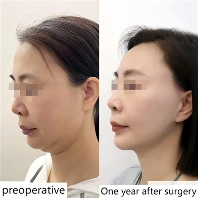 Forehead Lift