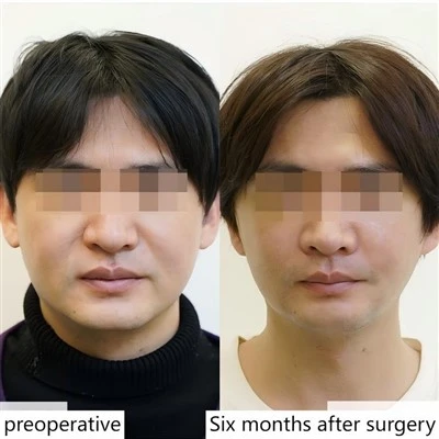 Male Facelift