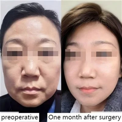 Nasolabial Fold Improvement
