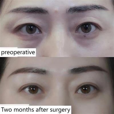 Natural Double Eyelids