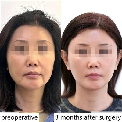 Necklift