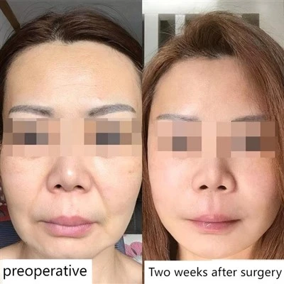 Skin Tightening Surgery