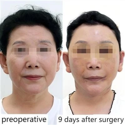 Surgery for Drooping Mouth Corners